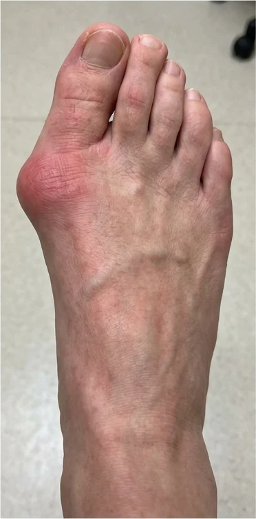 Foot with bunion before using the ReAlign corrector