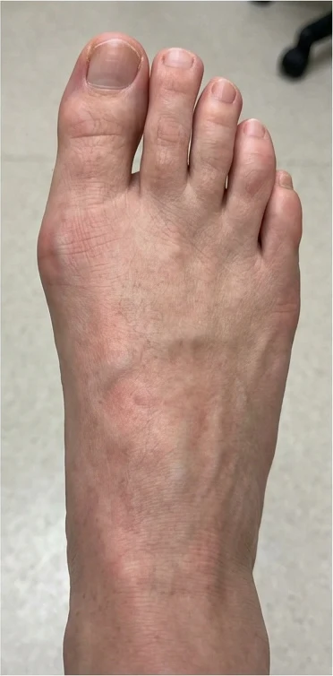 Foot with improved alignment after consistent ReAlign use